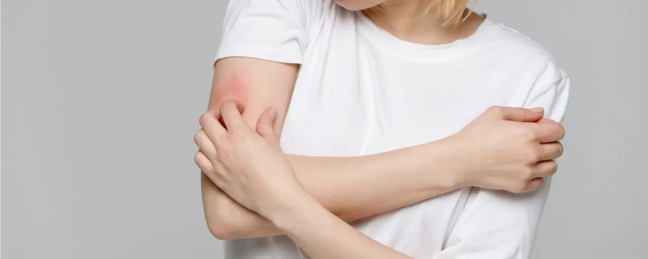 Se hai questo sintomo comune, potresti avere un’infestazione di acari e non saperlo